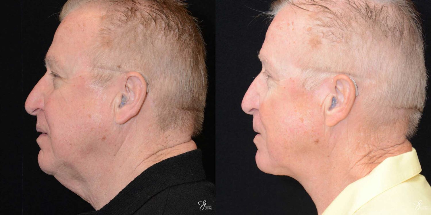 Male Face Neck Lift Before & After