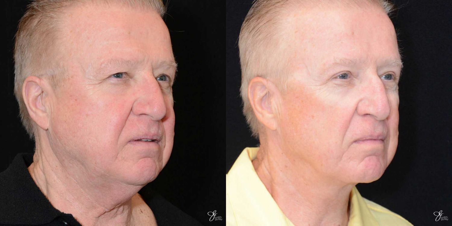 Male Face Neck Lift Before & After