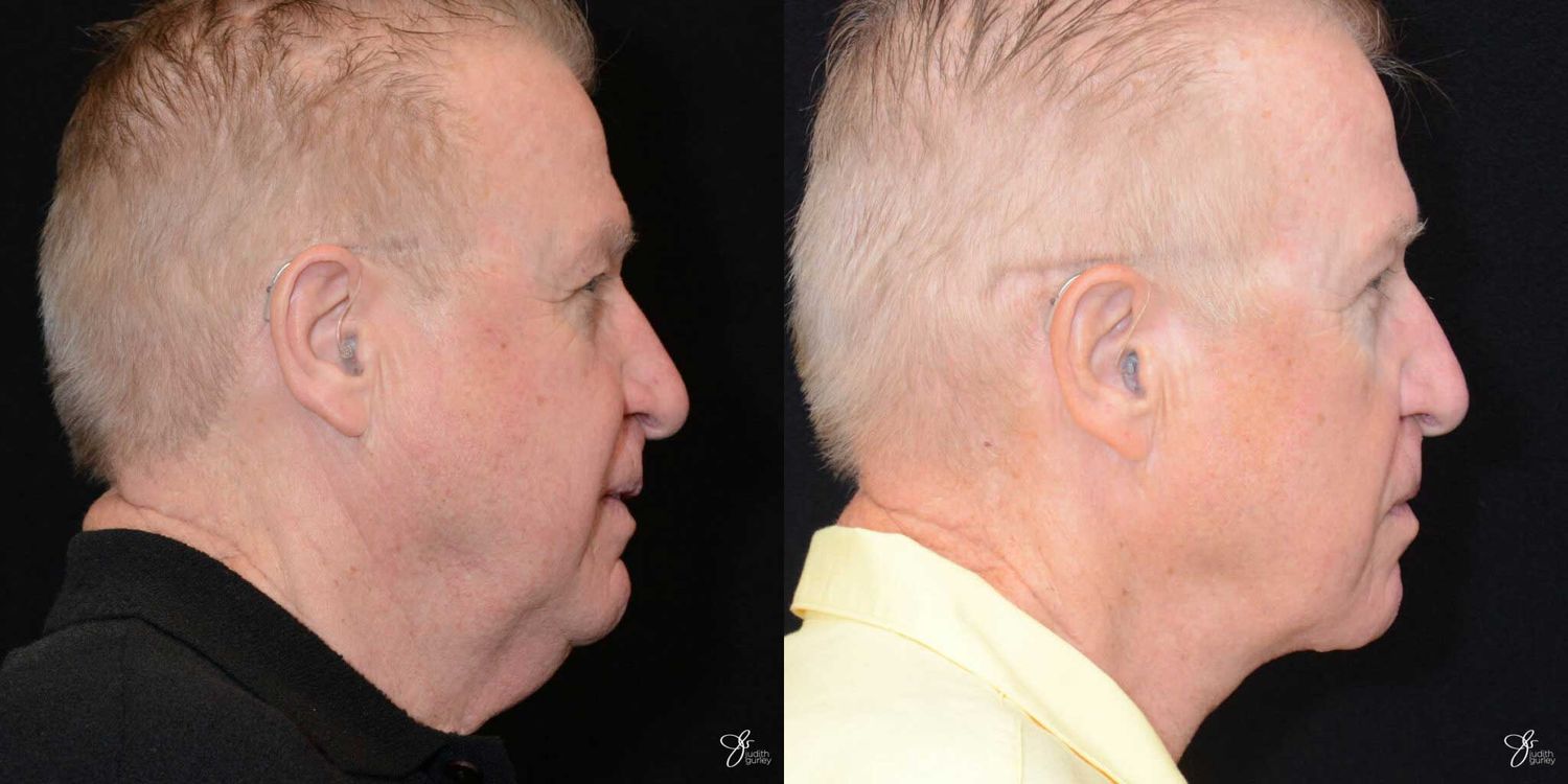 Male Face Neck Lift Before & After
