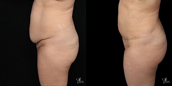 Mini Tummy Tuck Before & After