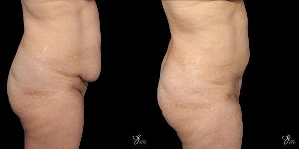 Mini Tummy Tuck Before & After