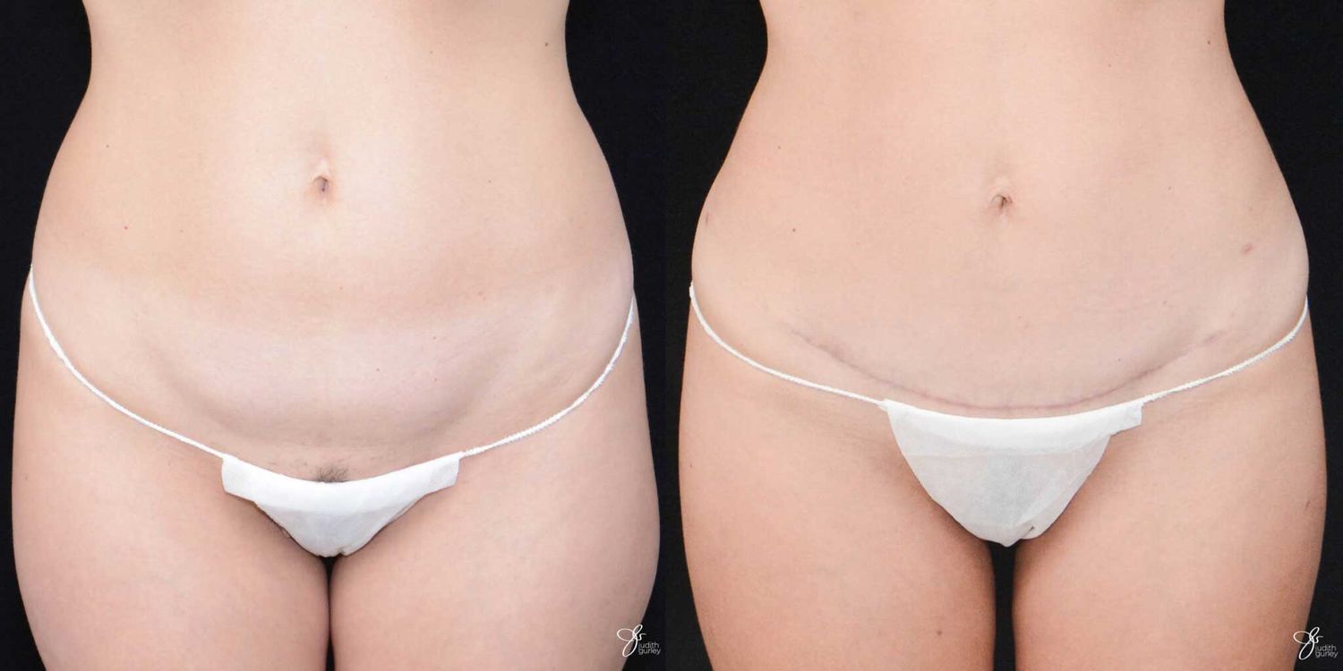 Mini Tummy Tuck Before & After