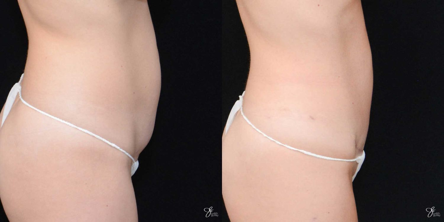 Mini Tummy Tuck Before & After