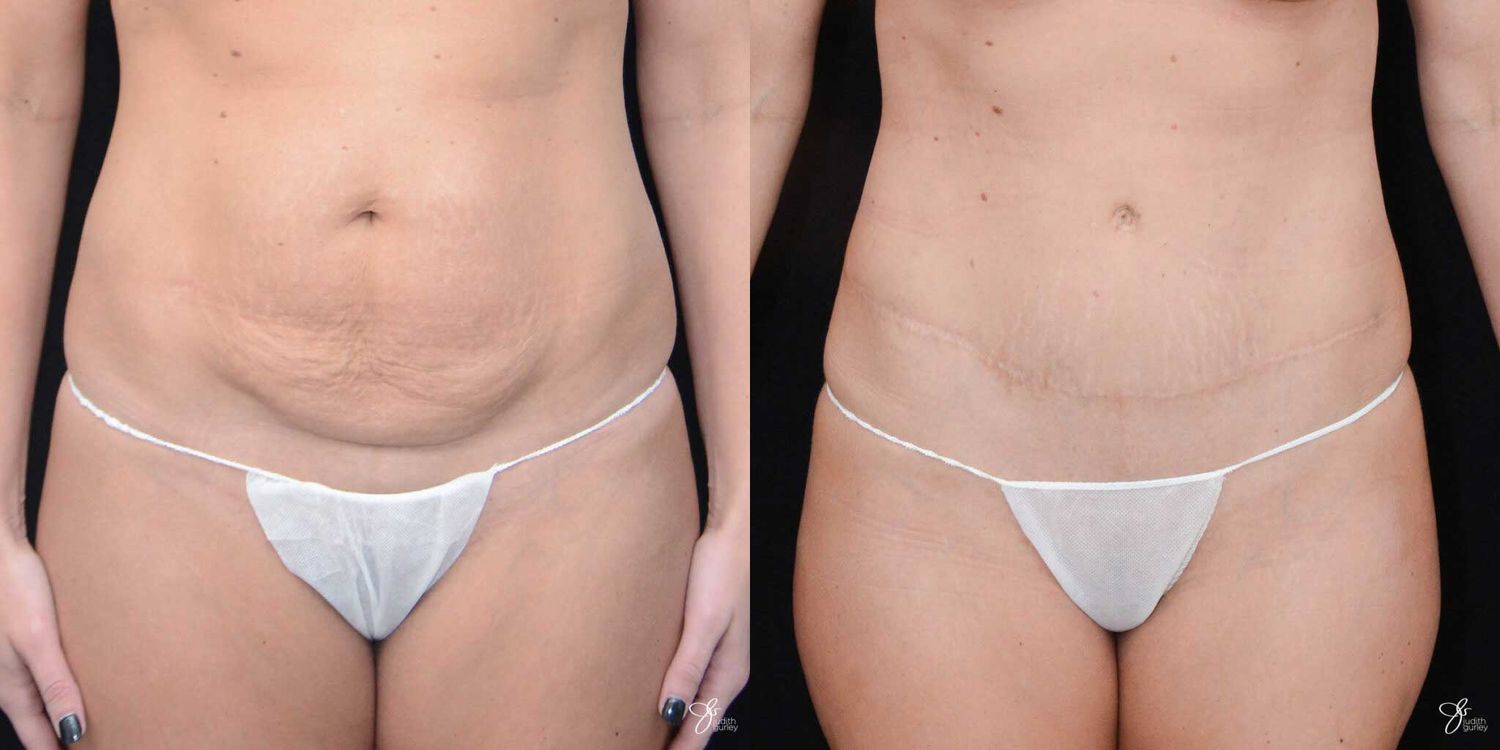 Mini Tummy Tuck Before & After