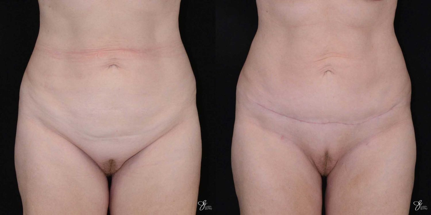 Mini Tummy Tuck Before & After
