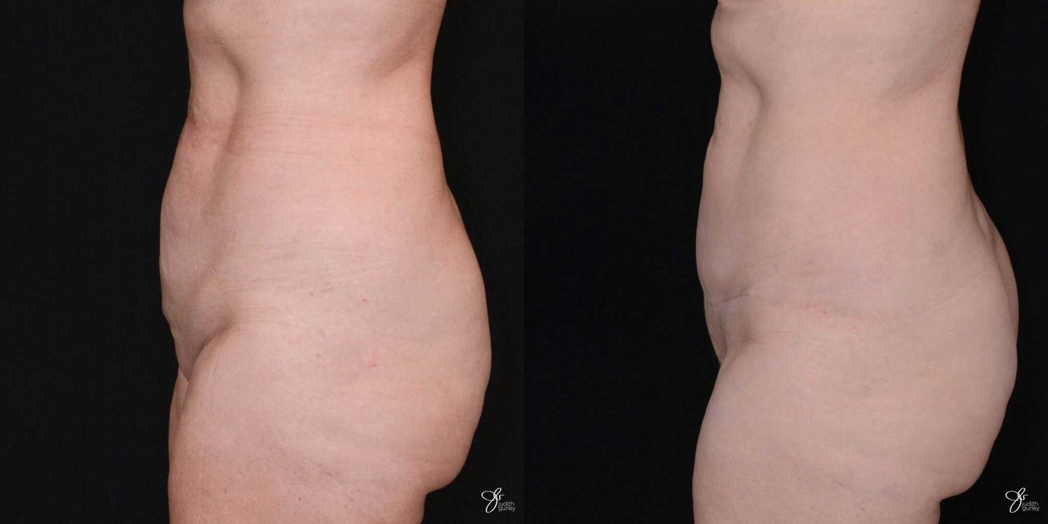Mini Tummy Tuck Before & After
