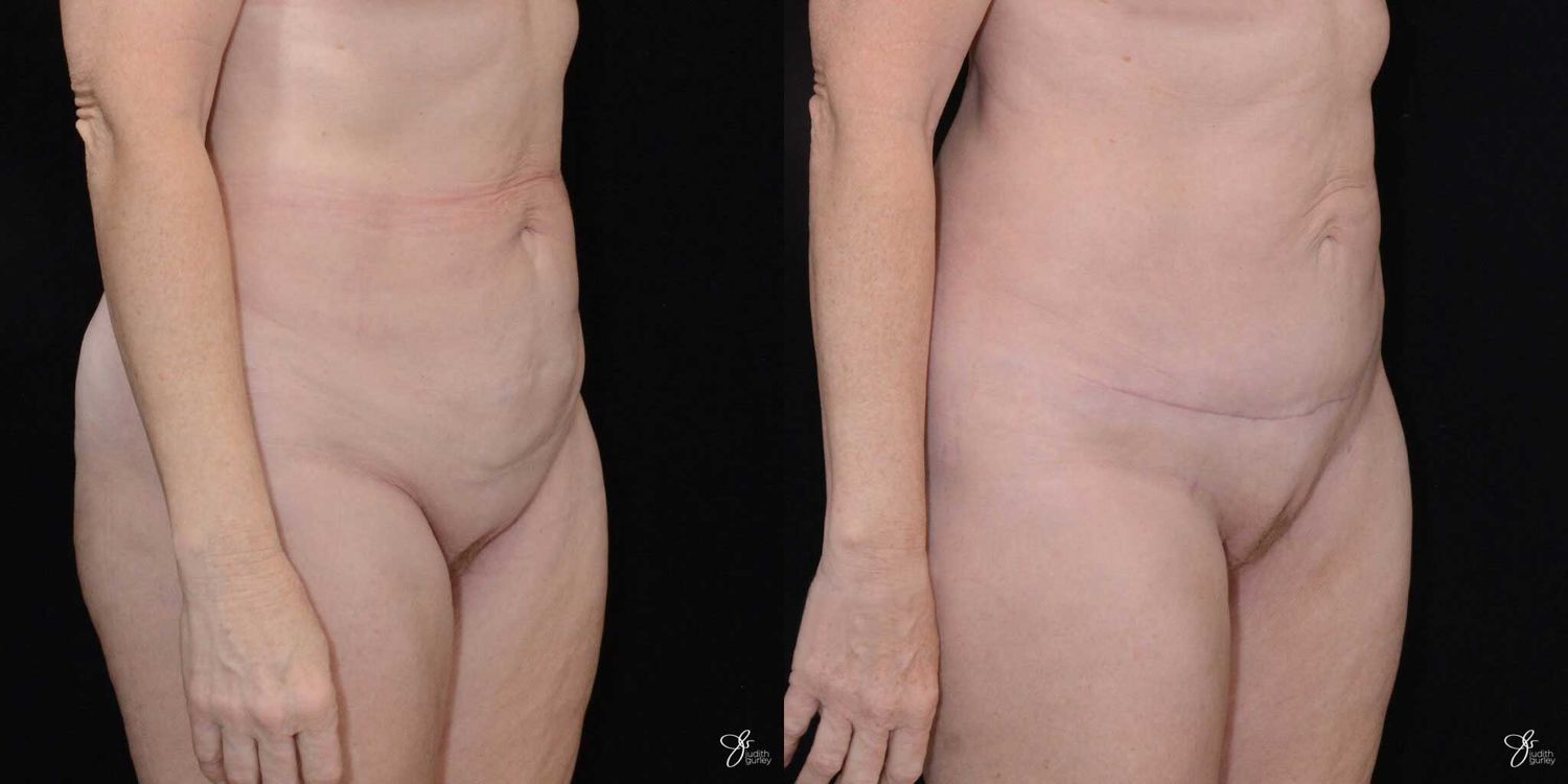 Mini Tummy Tuck Before & After