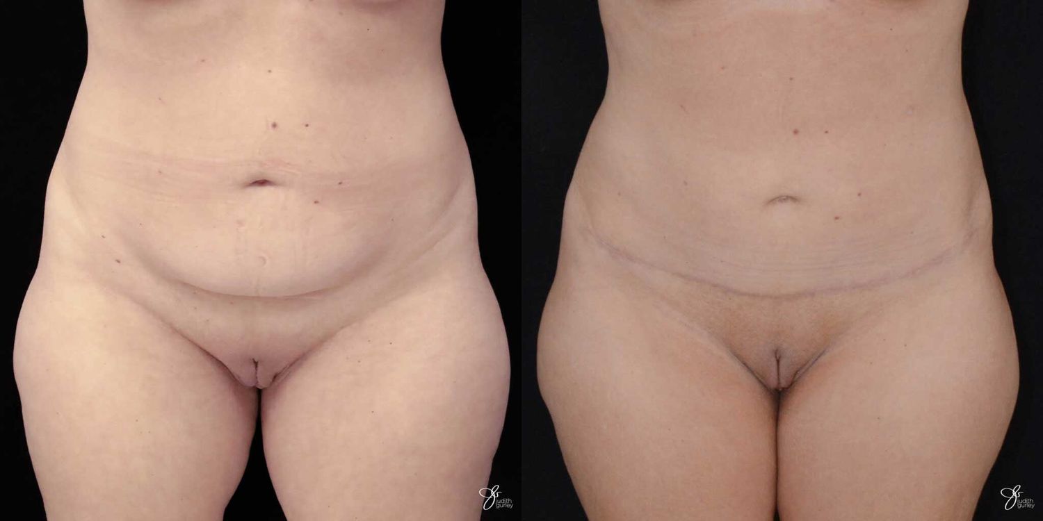 Mini Tummy Tuck Before & After