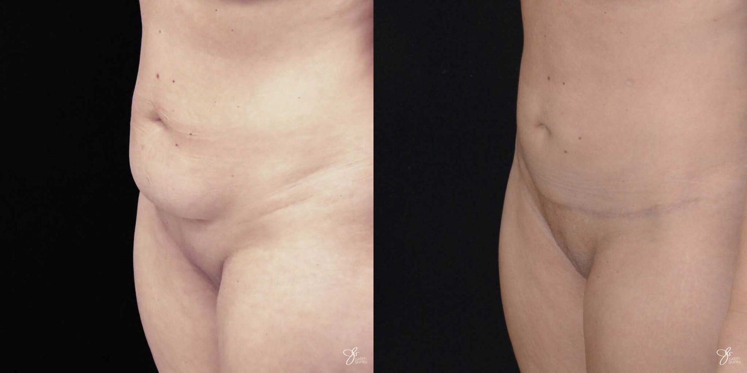 Mini Tummy Tuck Before & After