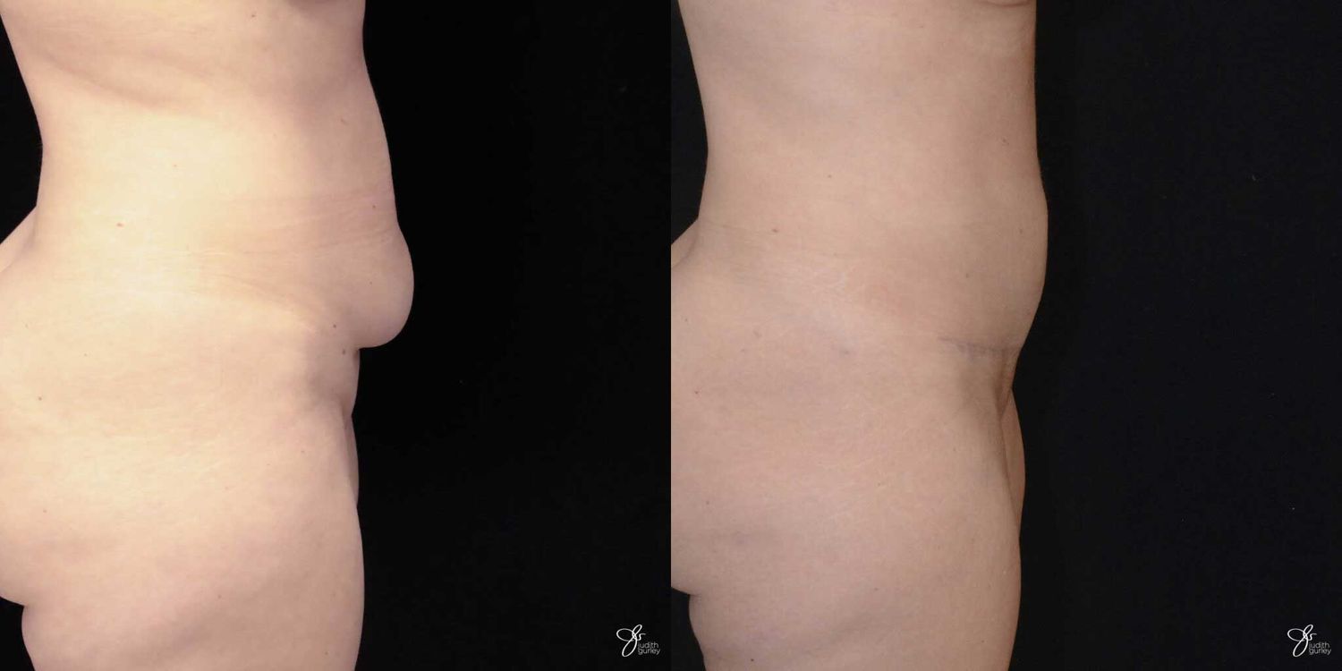 Mini Tummy Tuck Before & After