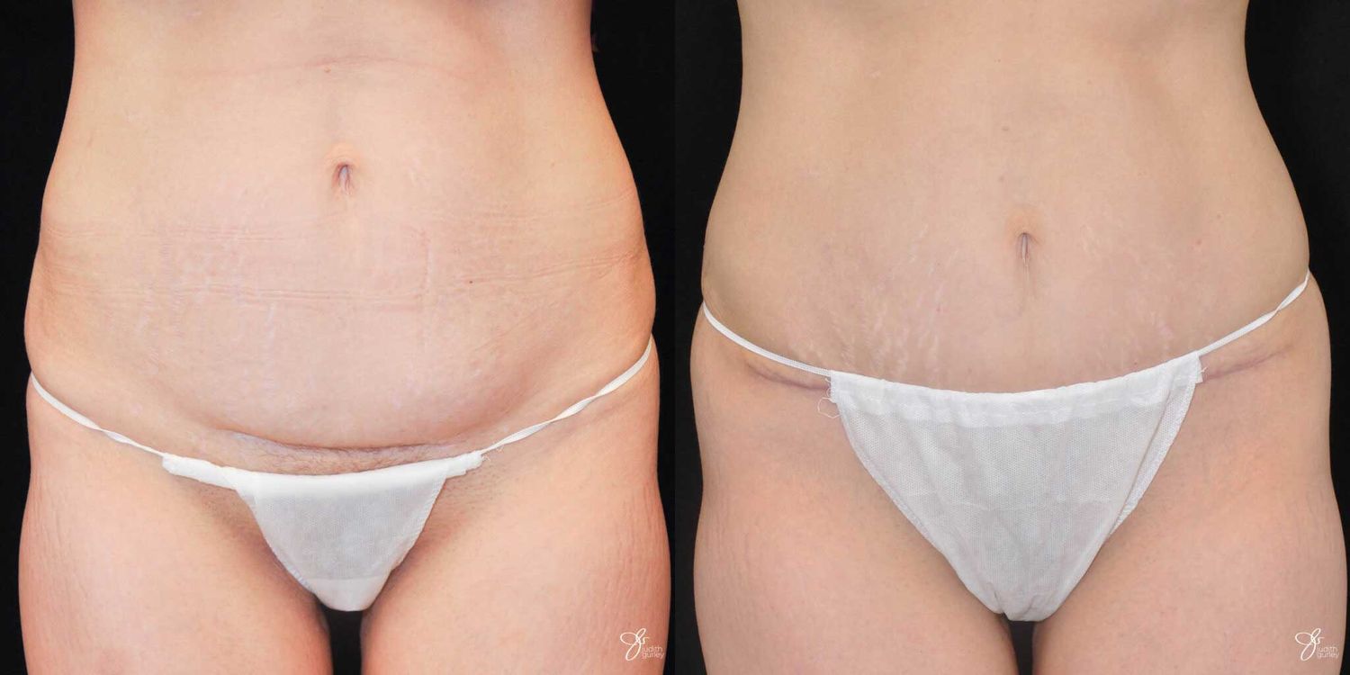 Mini Tummy Tuck Before & After