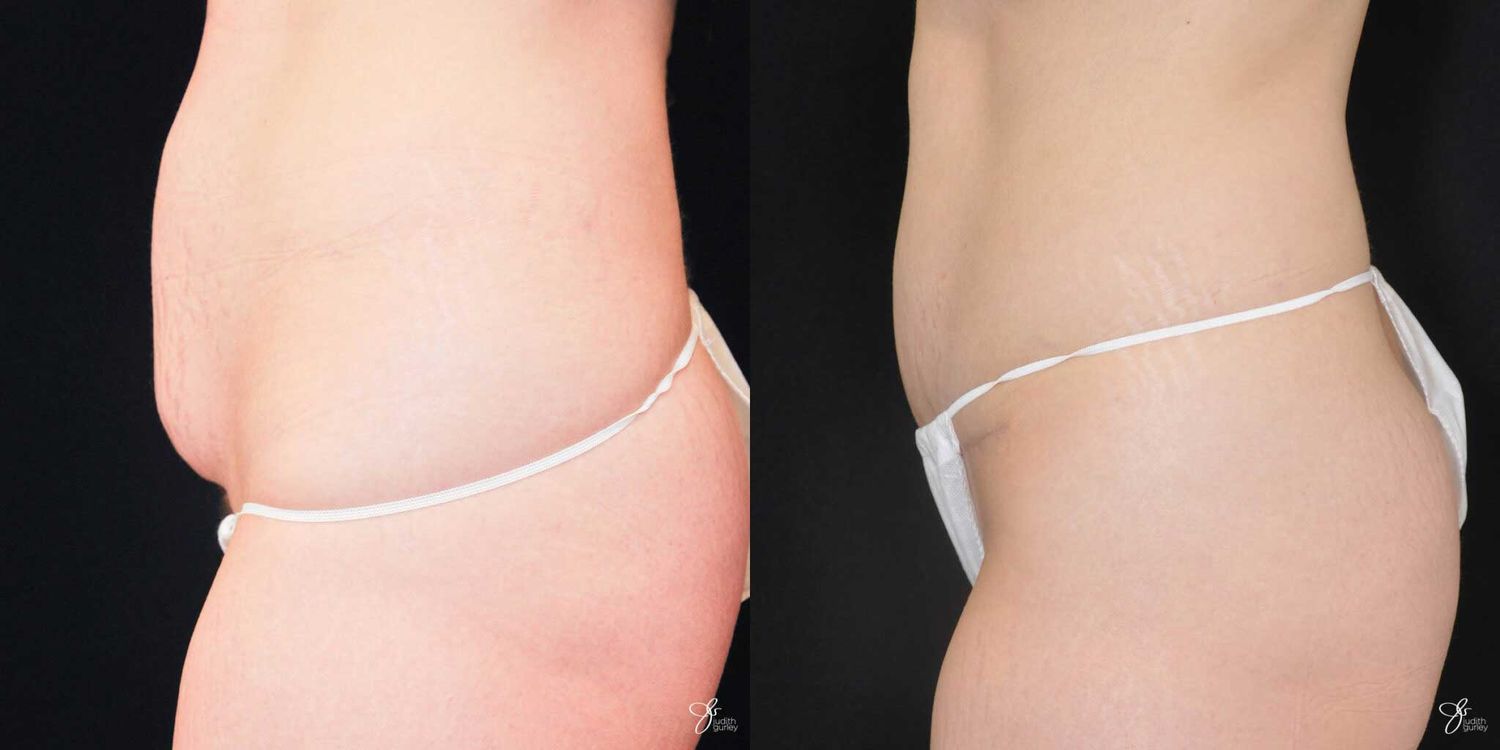 Mini Tummy Tuck Before & After
