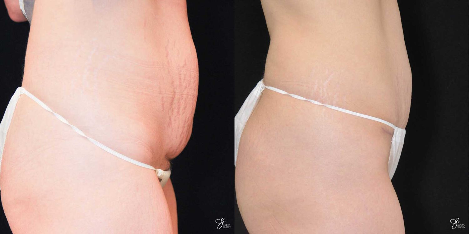 Mini Tummy Tuck Before & After