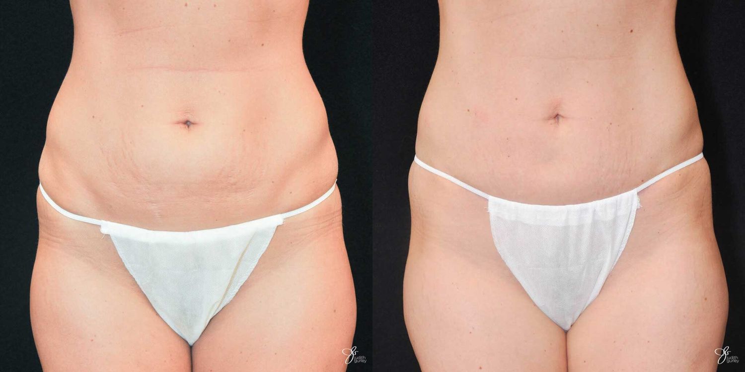 Mini Tummy Tuck Before & After