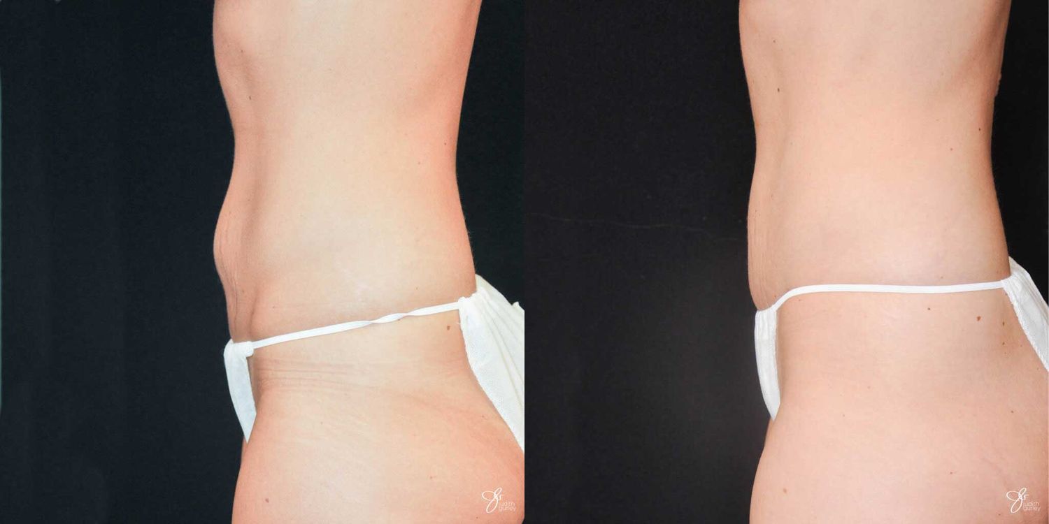 Mini Tummy Tuck Before & After