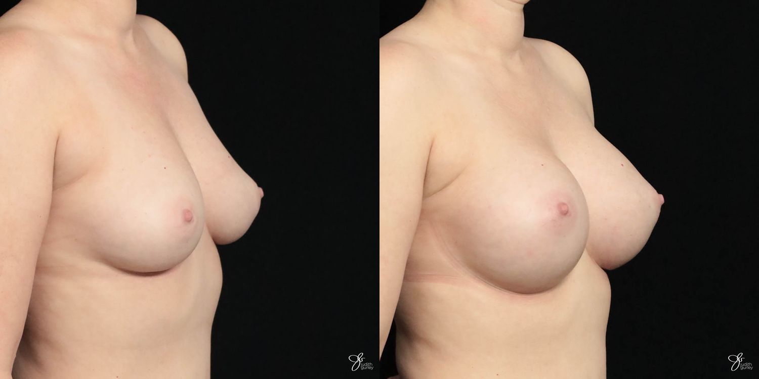 Breast Augmentation Before & After