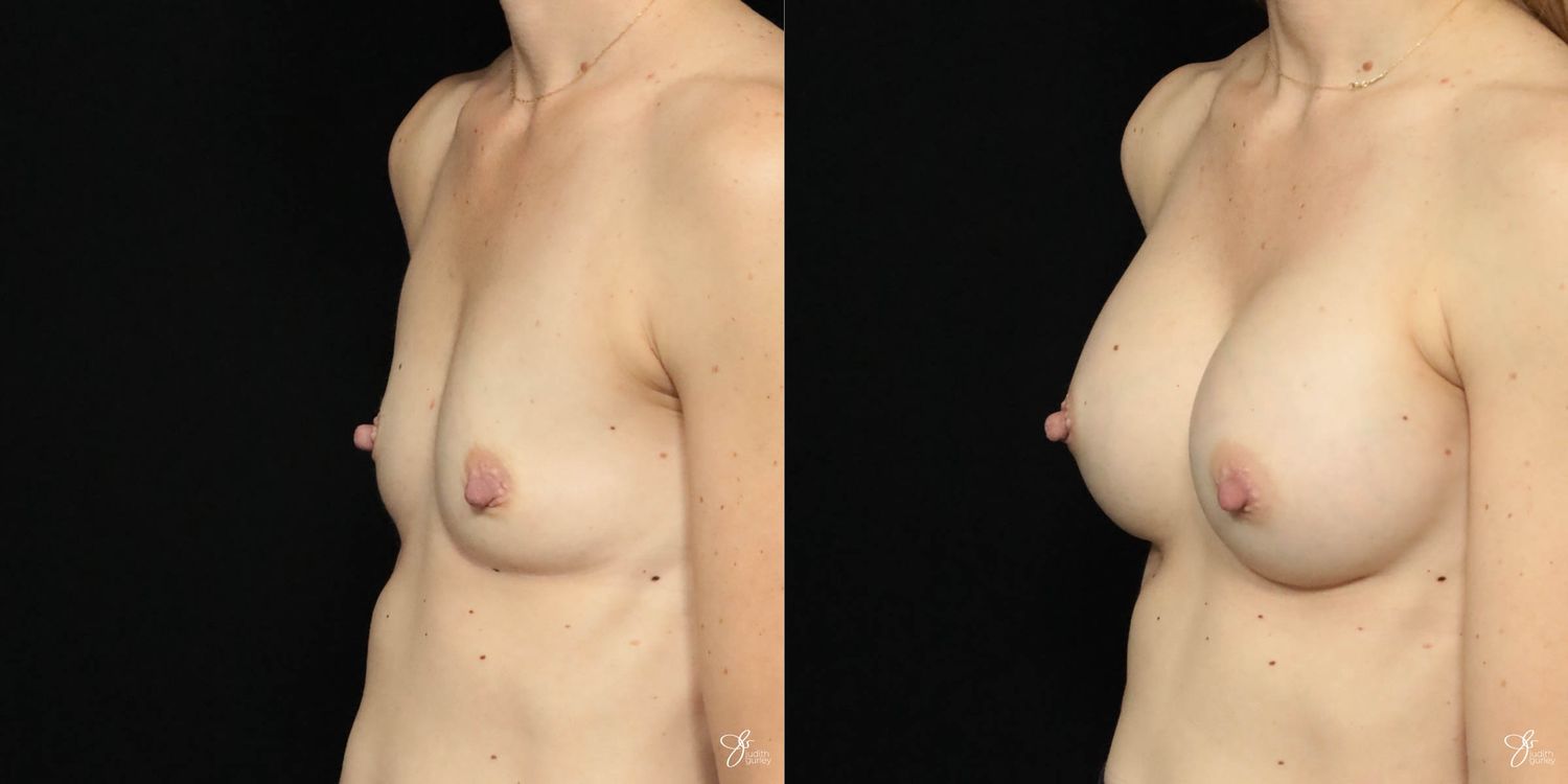 Breast Augmentation Before & After