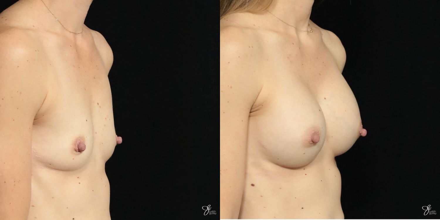 Breast Augmentation Before & After