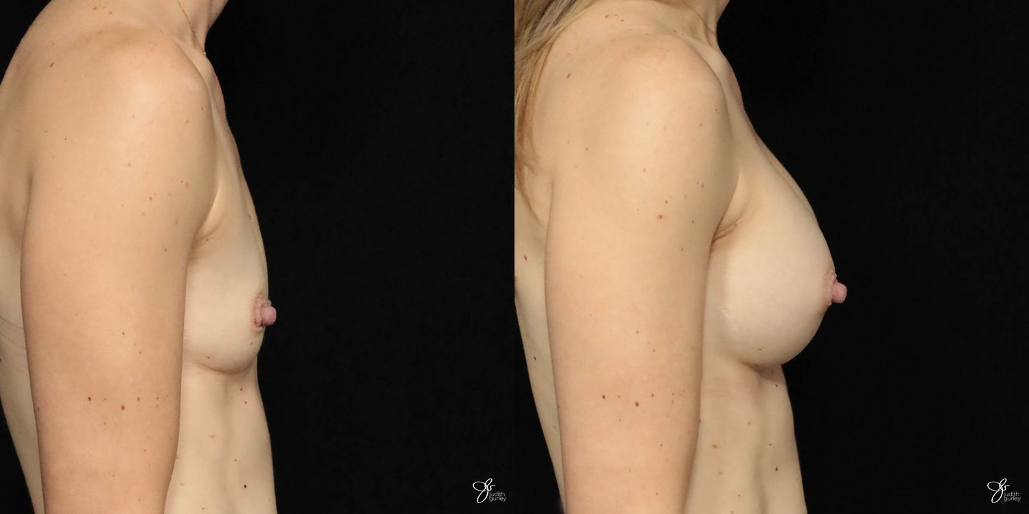 Breast Augmentation Before & After