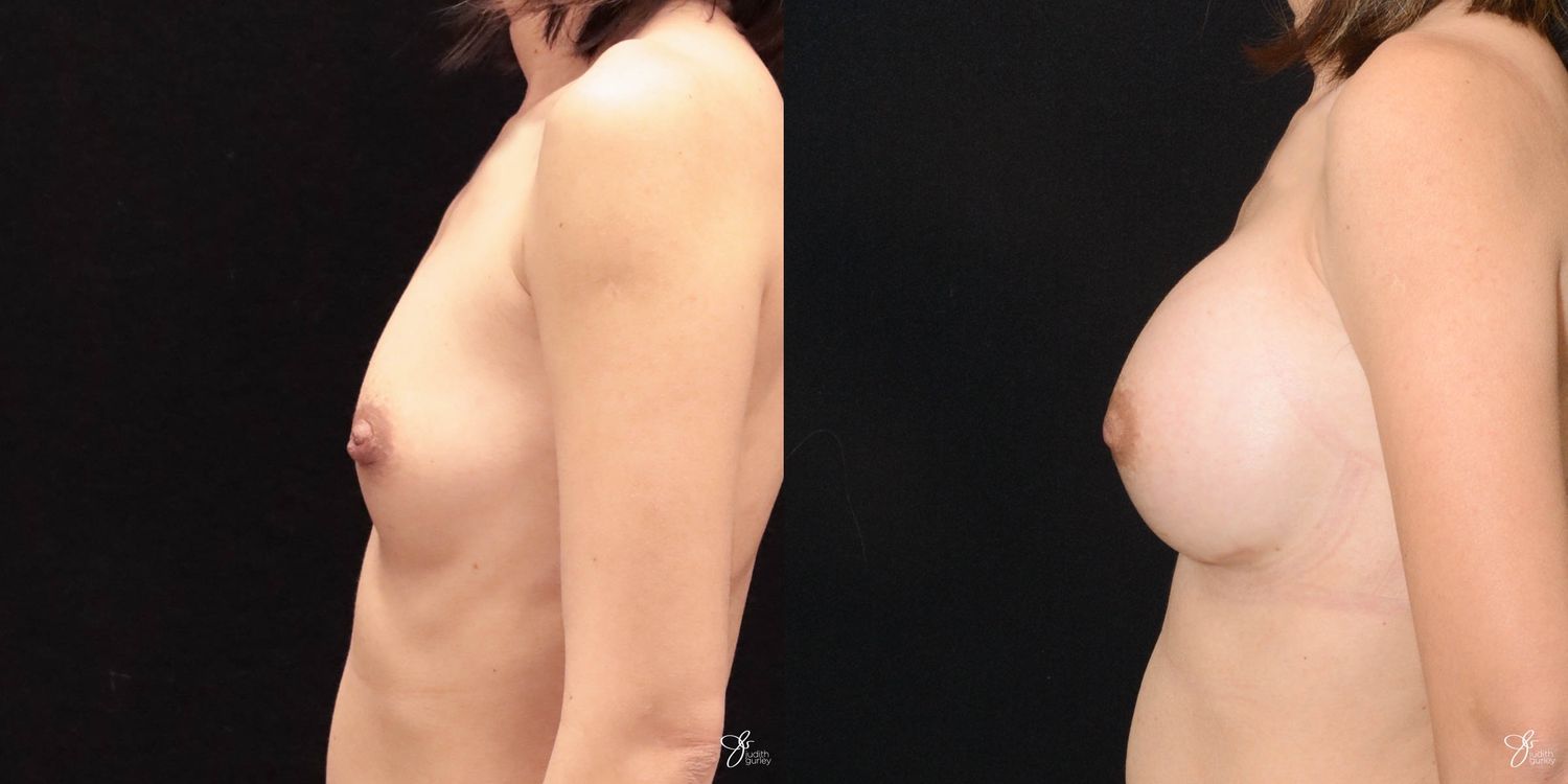 Breast Augmentation Before & After