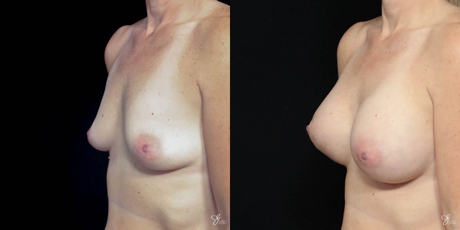 Breast Augmentation Before & After