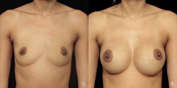 Breast Augmentation Before & After