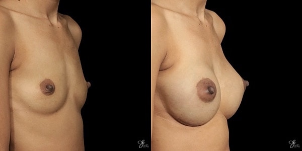 Breast Augmentation Before & After