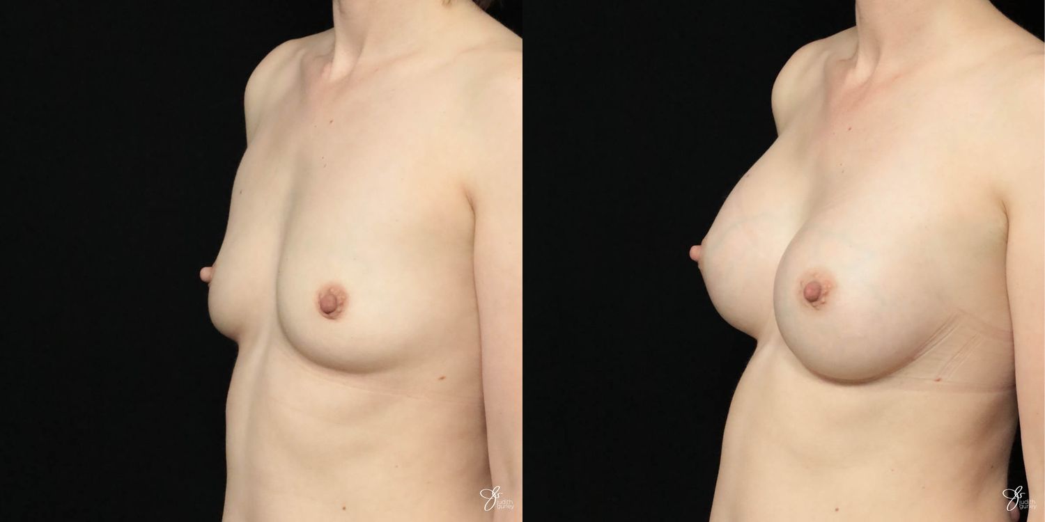 Breast Augmentation Before & After