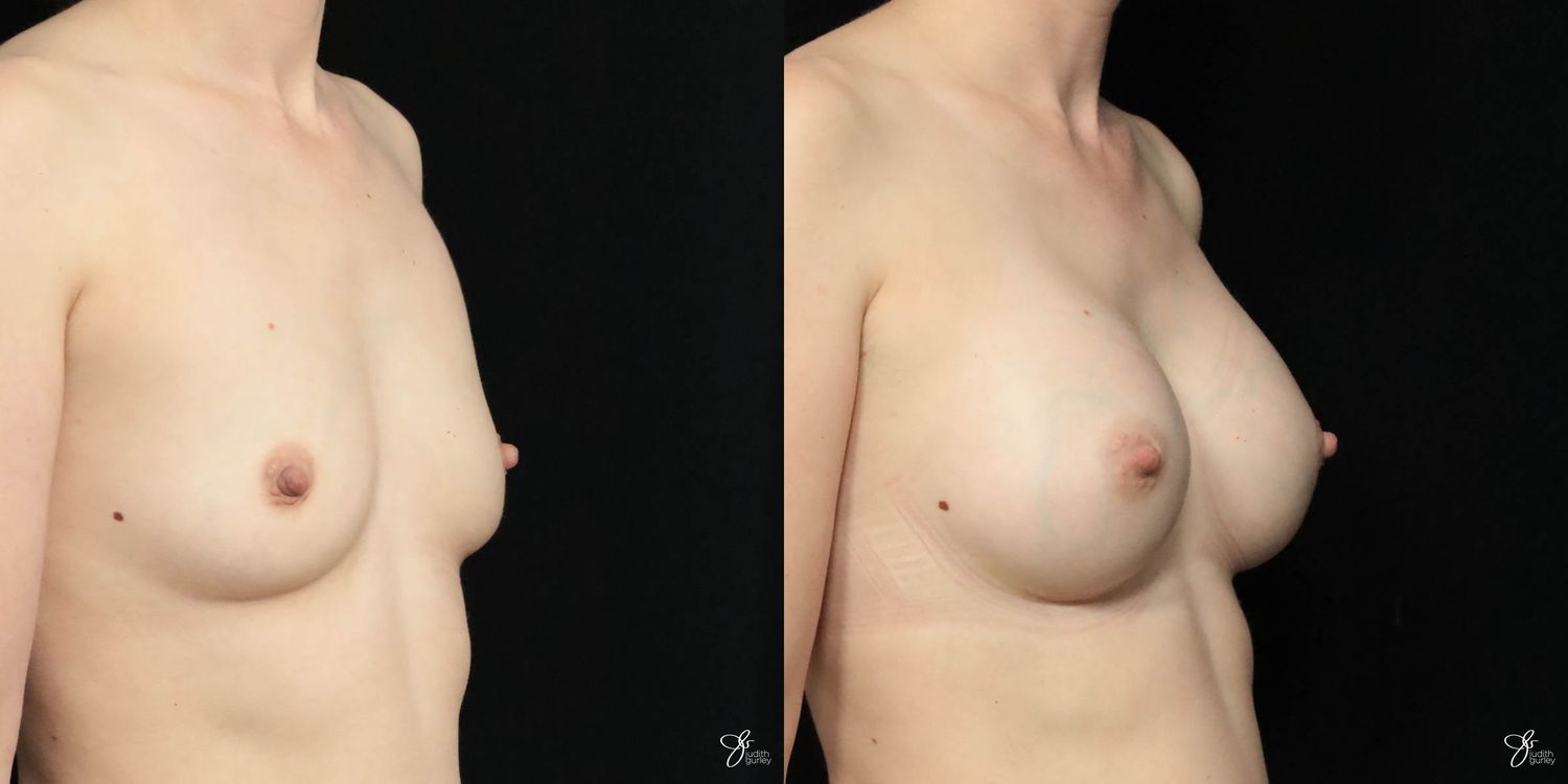 Breast Augmentation Before & After