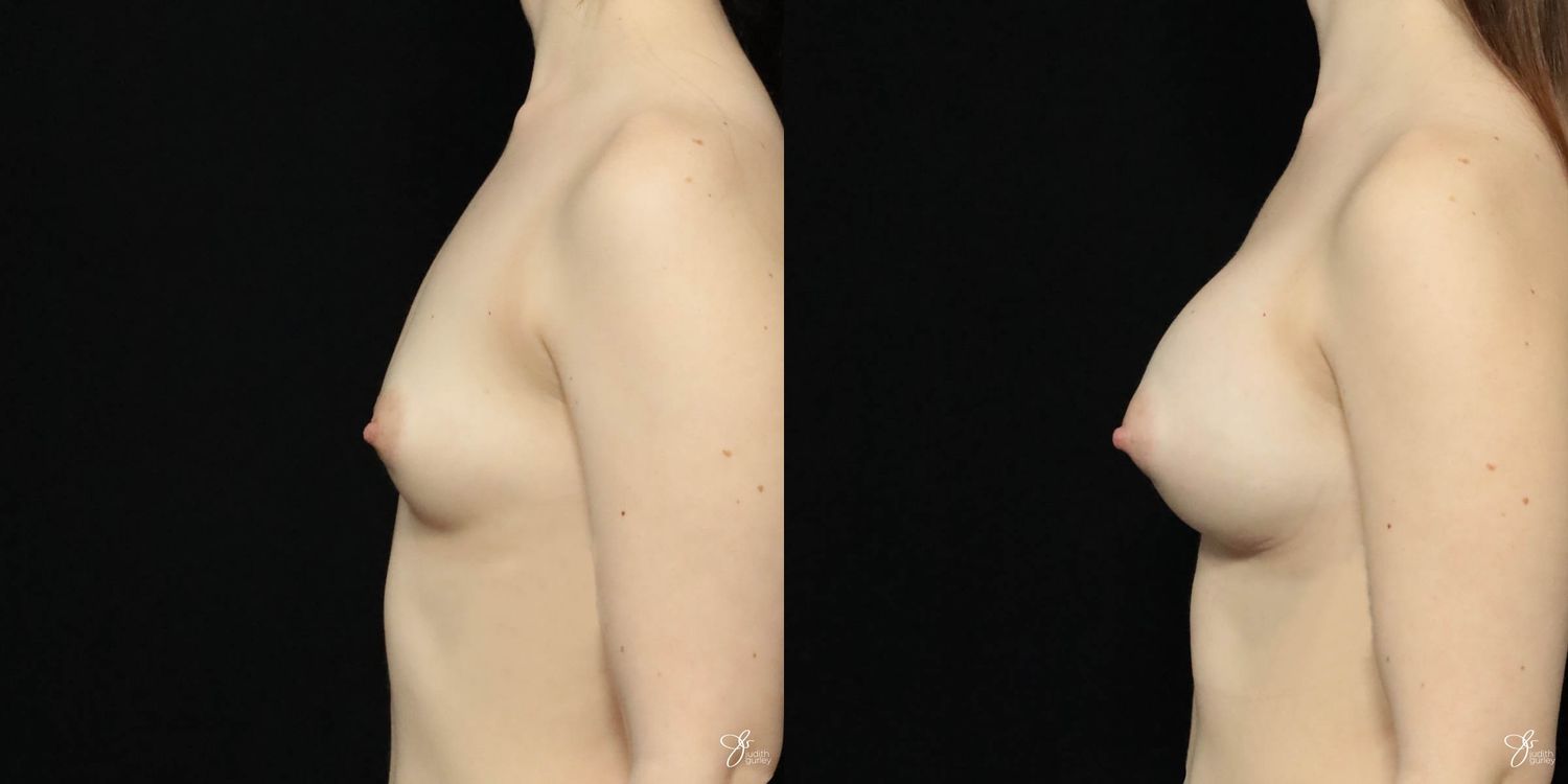 Breast Augmentation Before & After