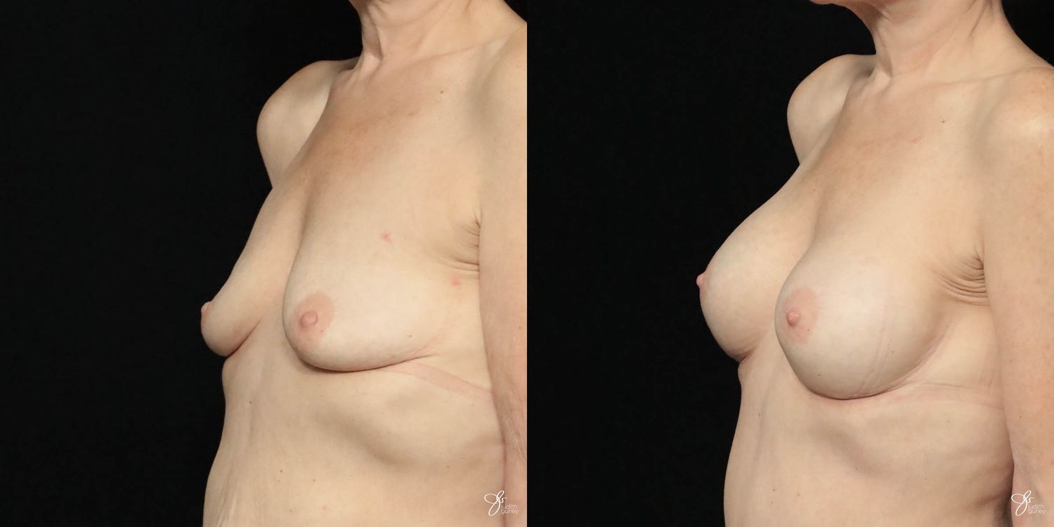 Breast Augmentation Before & After