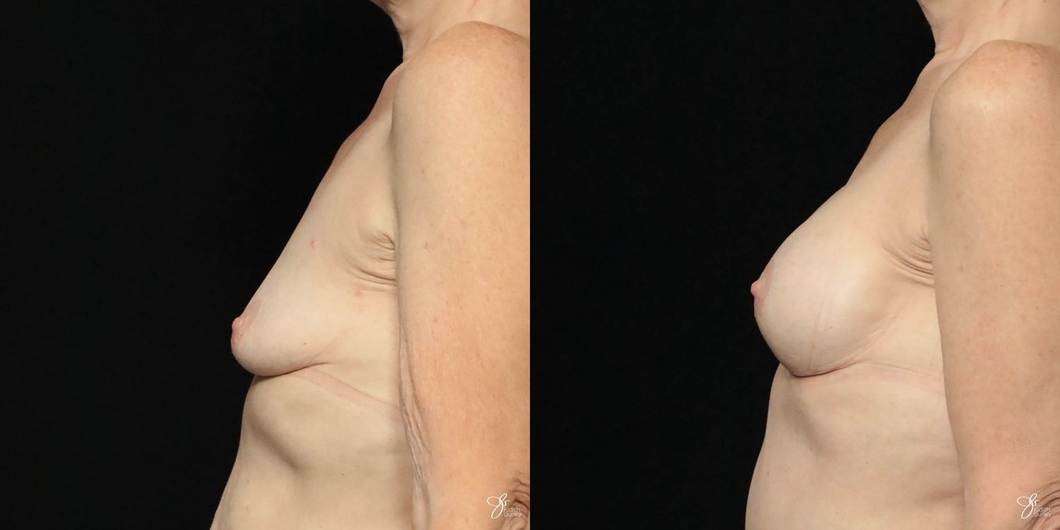 Breast Augmentation Before & After