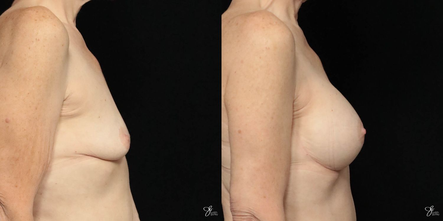Breast Augmentation Before & After