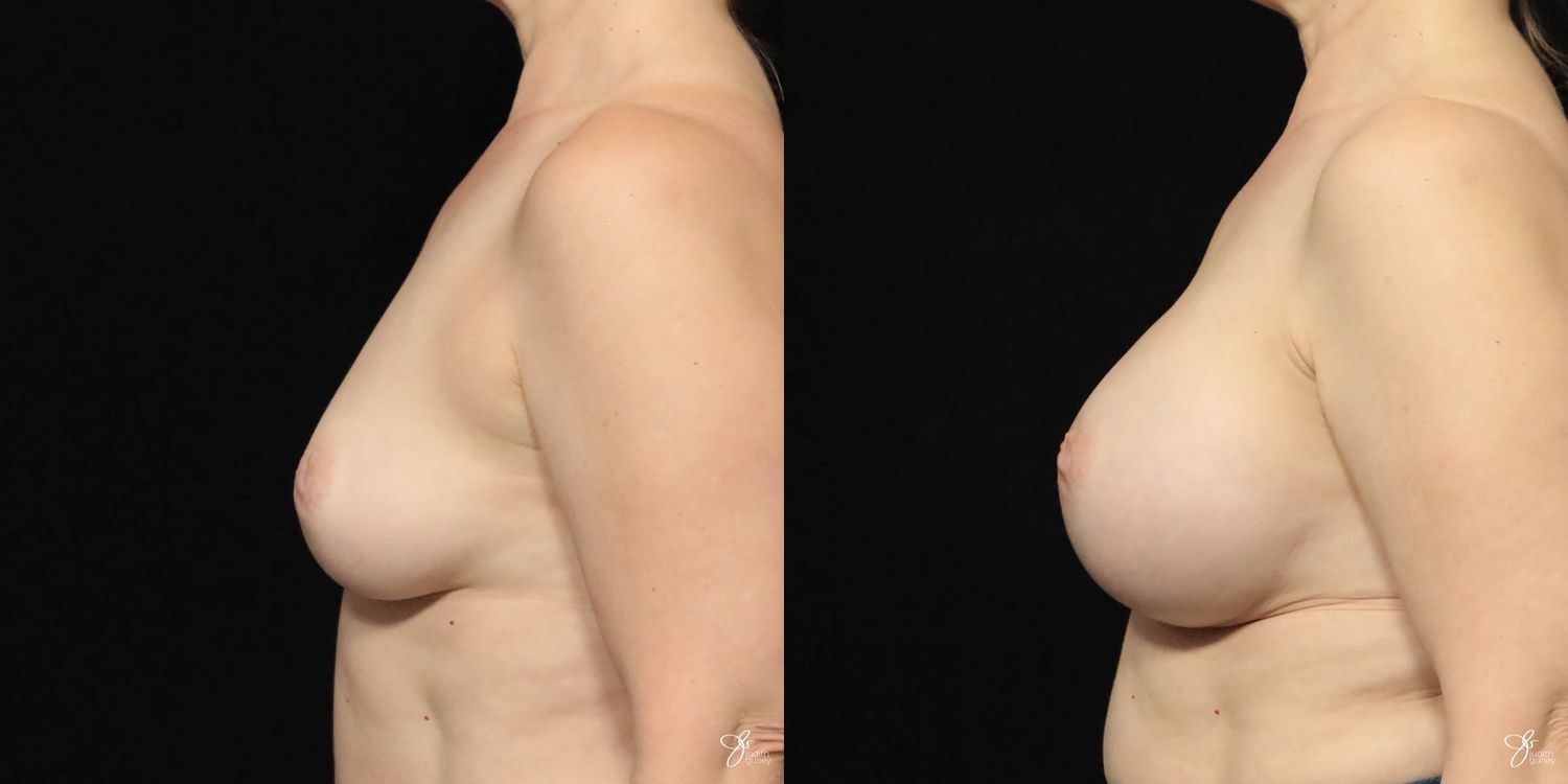 Breast Augmentation Before & After