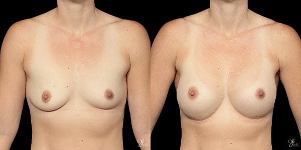 Breast Augmentation Before & After