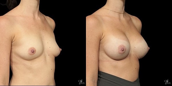 Breast Augmentation Before & After