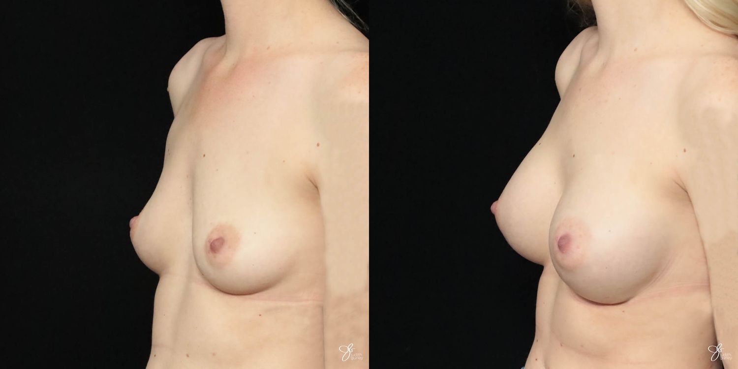 Breast Augmentation Before & After