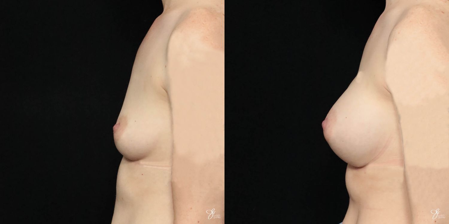 Breast Augmentation Before & After