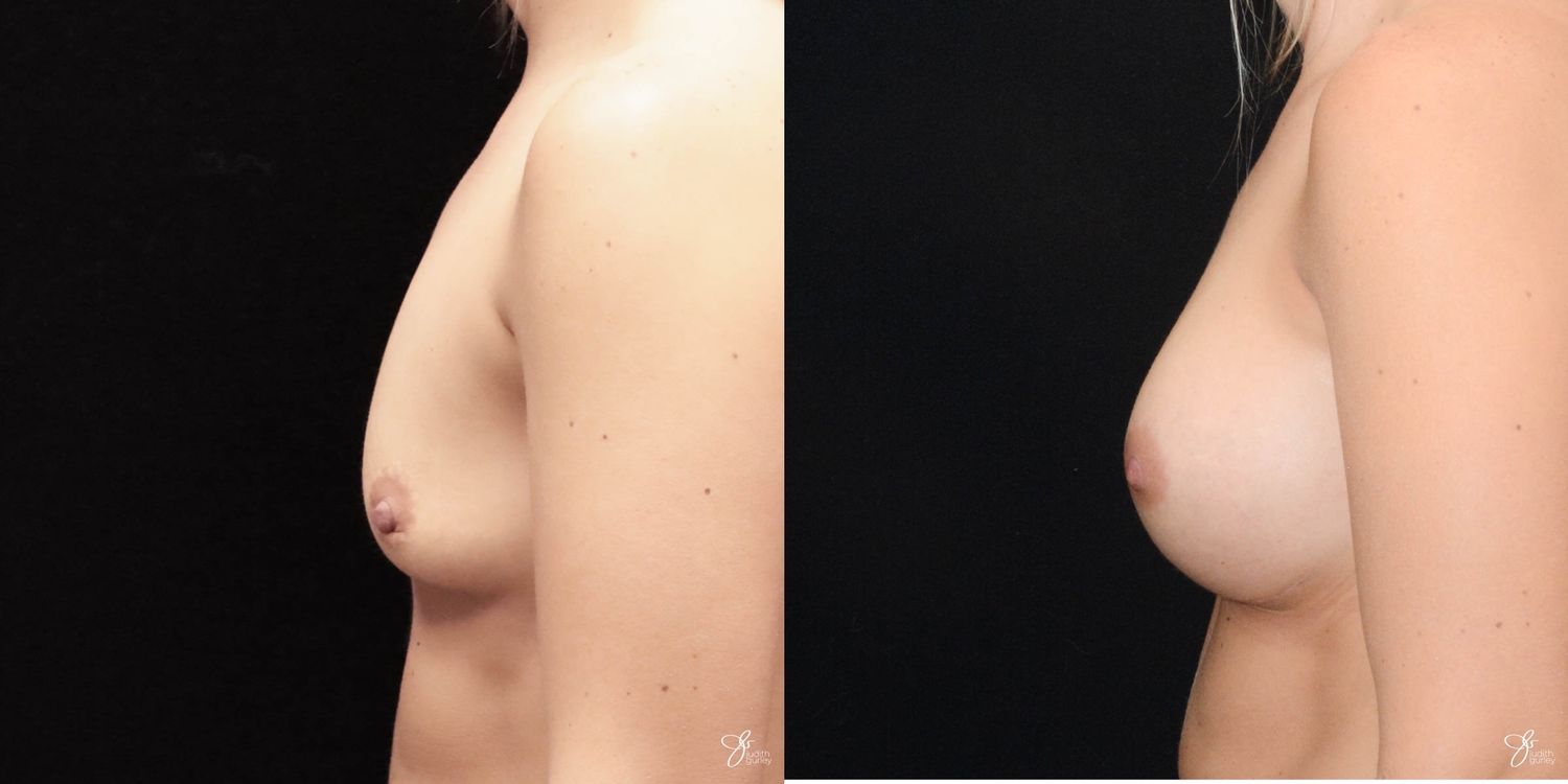 Breast Augmentation Before & After