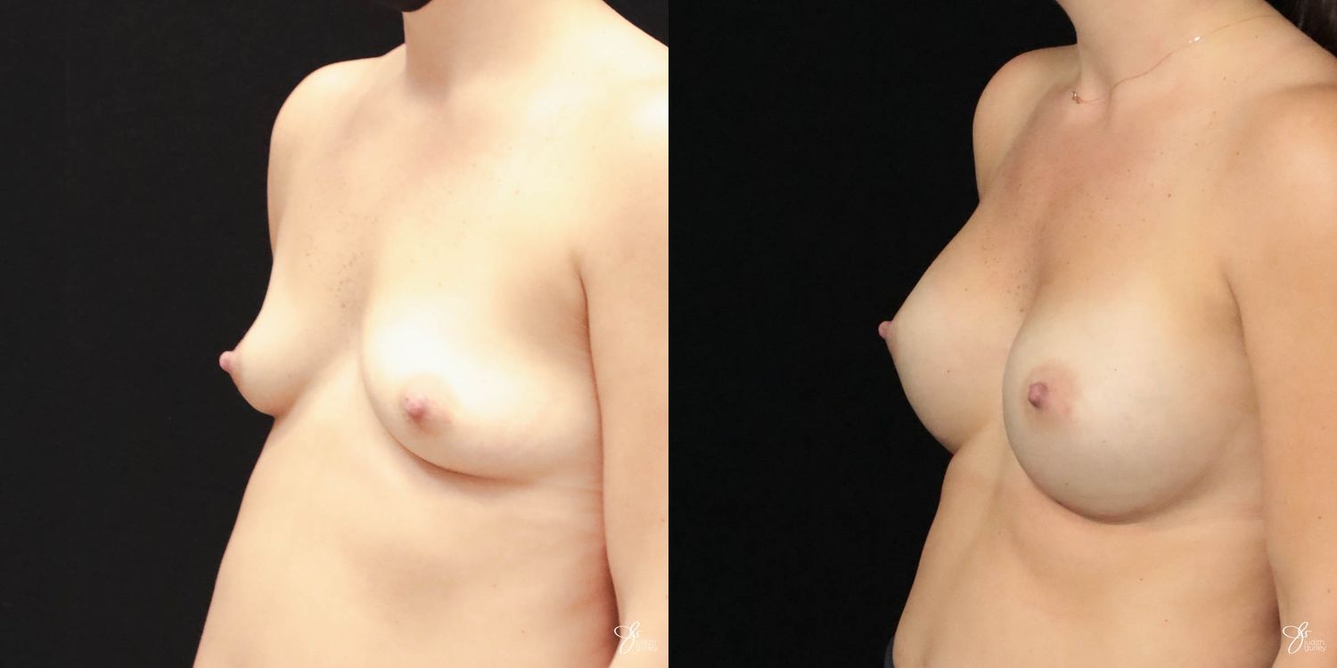 Breast Augmentation Before & After