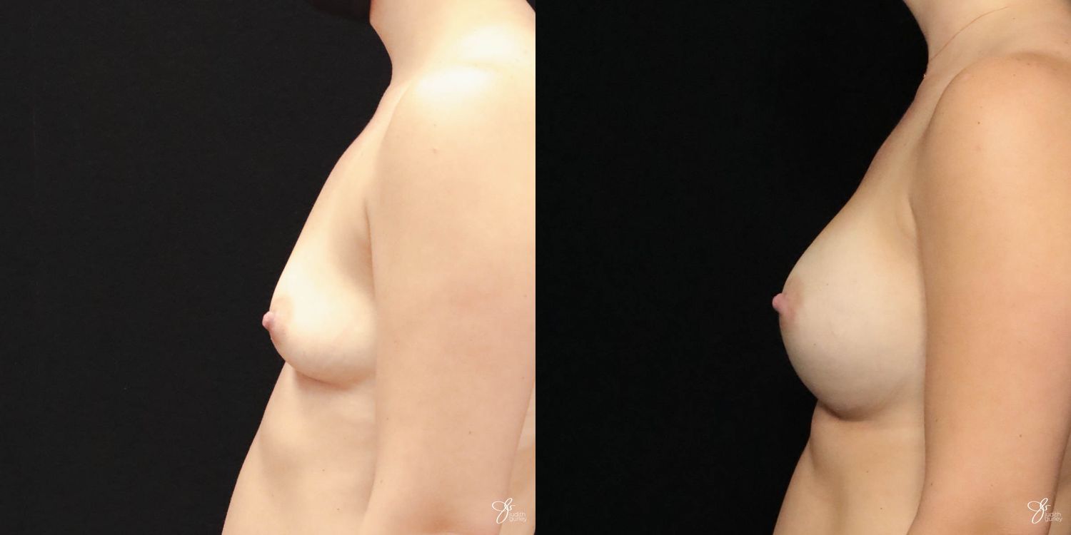 Breast Augmentation Before & After