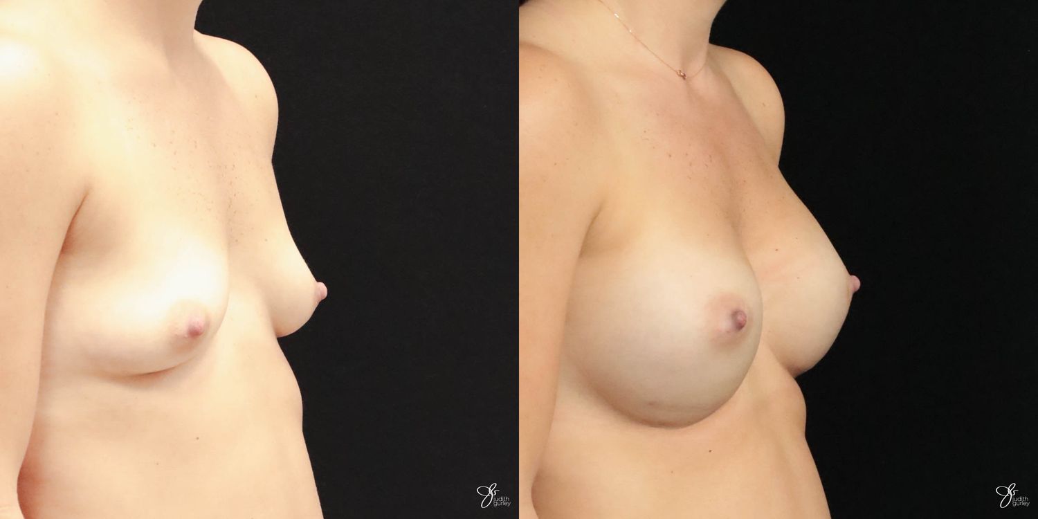 Breast Augmentation Before & After