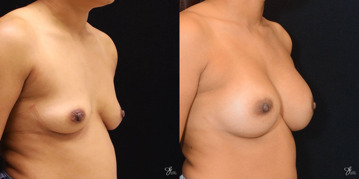 Breast Augmentation Before & After