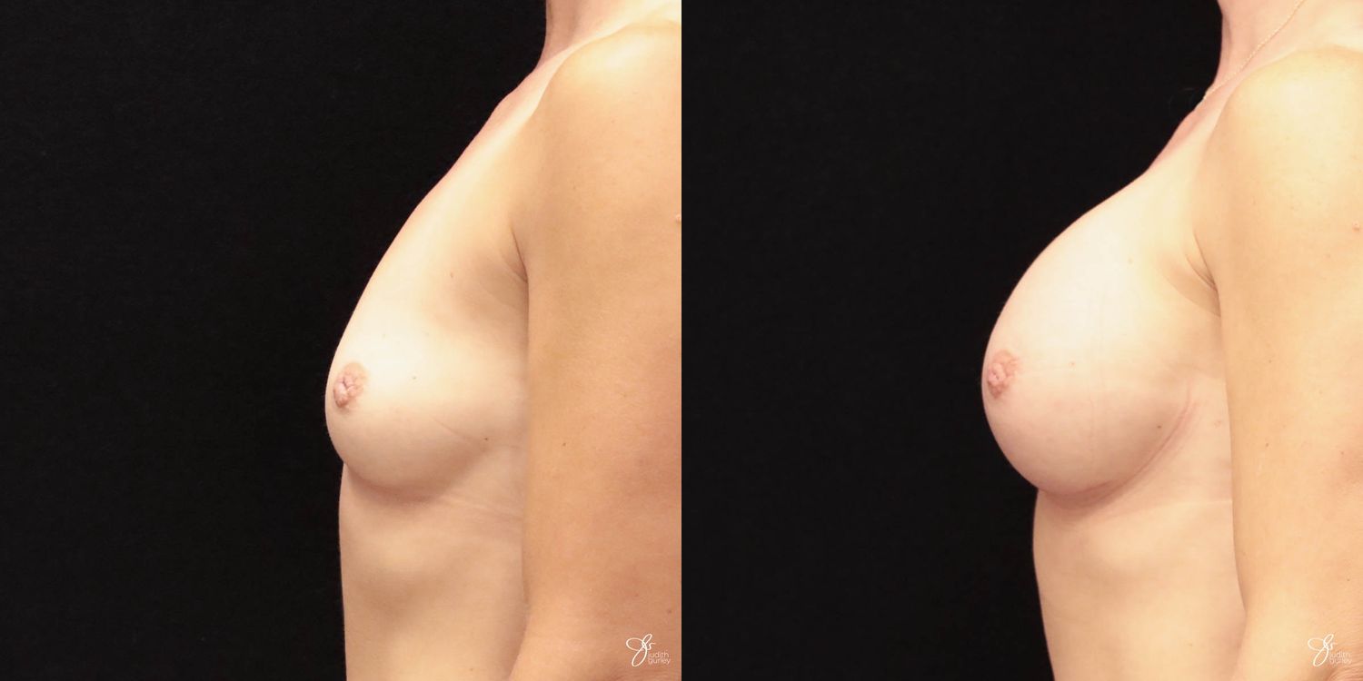 Breast Augmentation Before & After