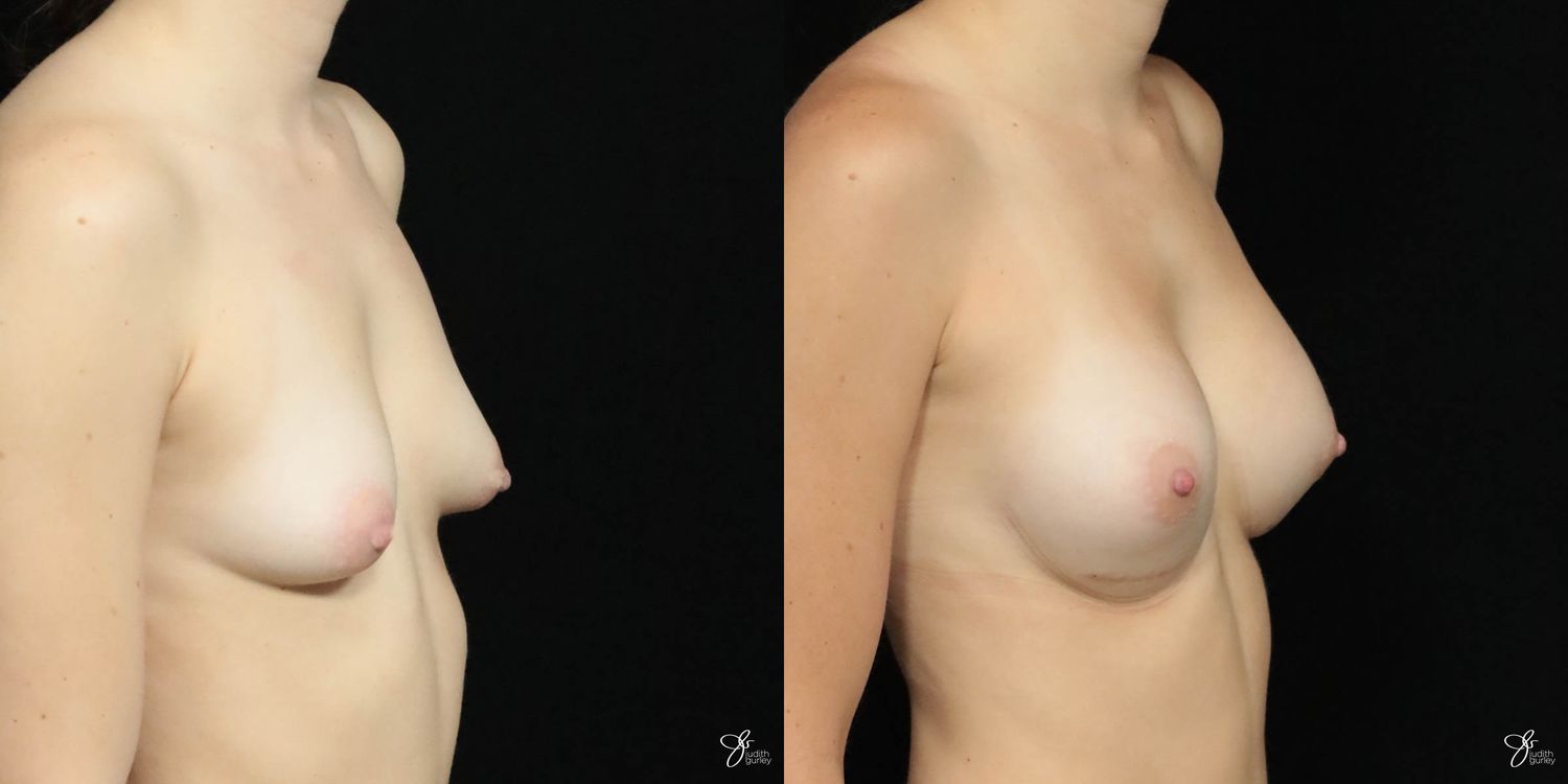 Breast Augmentation Before & After