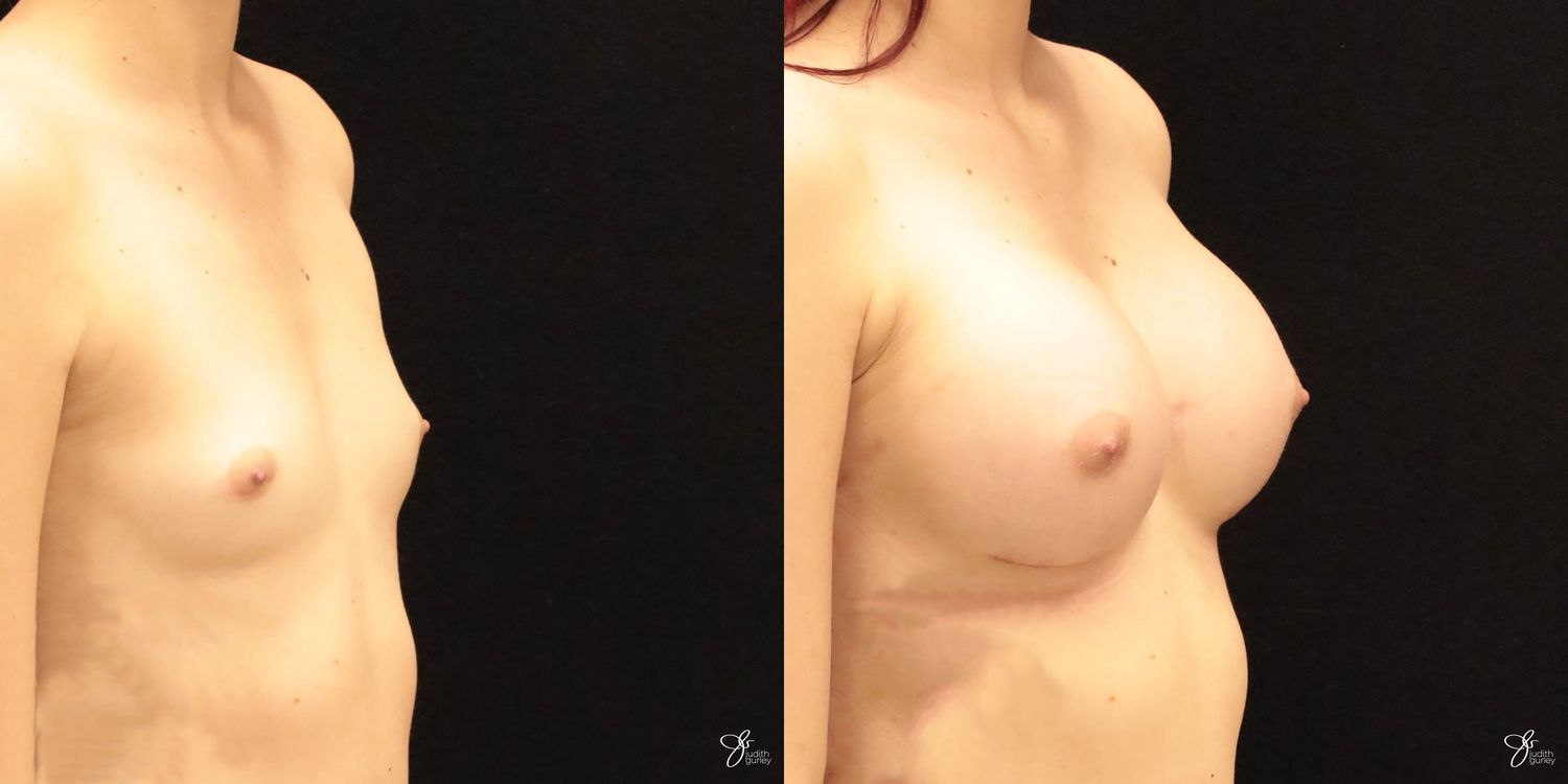 Breast Augmentation Before & After