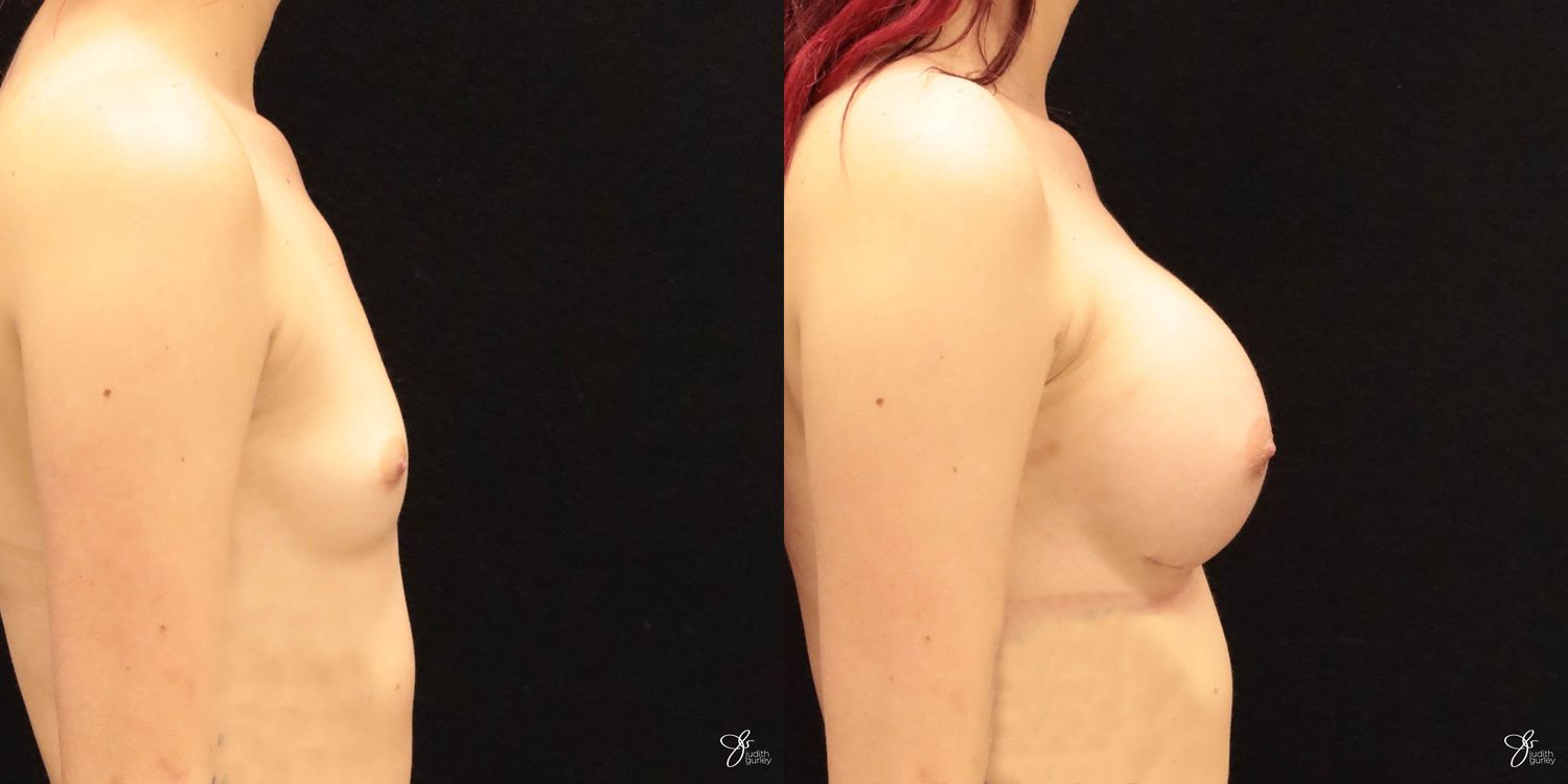 Breast Augmentation Before & After