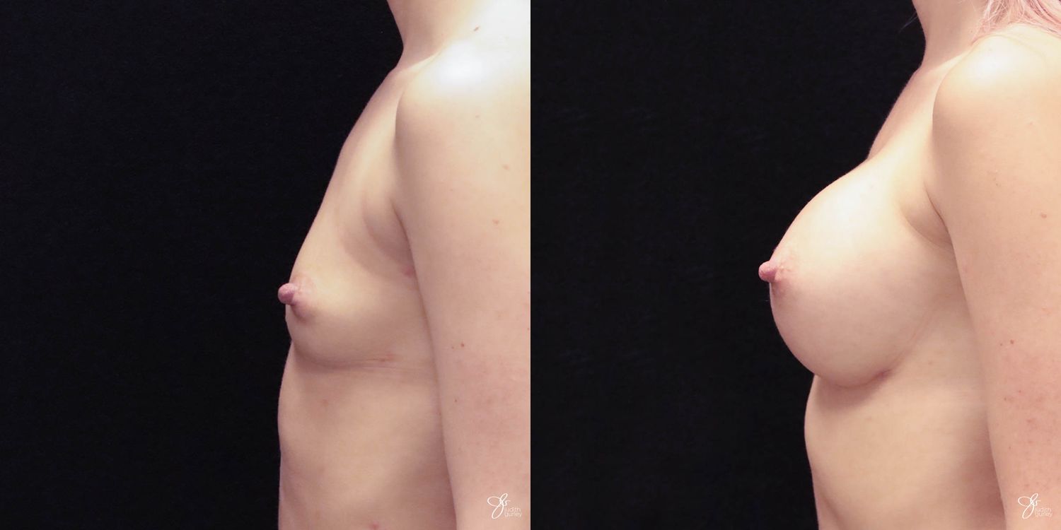 Breast Augmentation Before & After