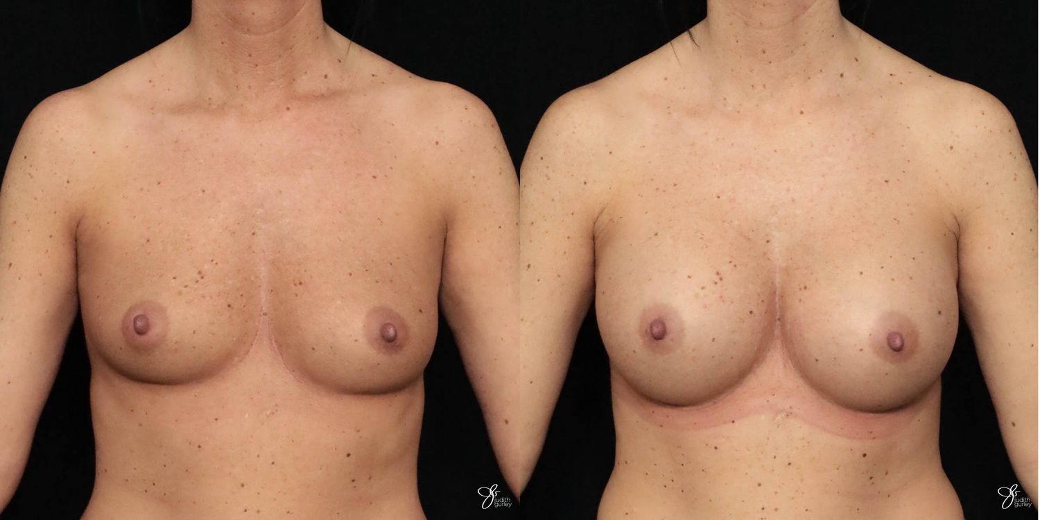 Breast Augmentation Before & After