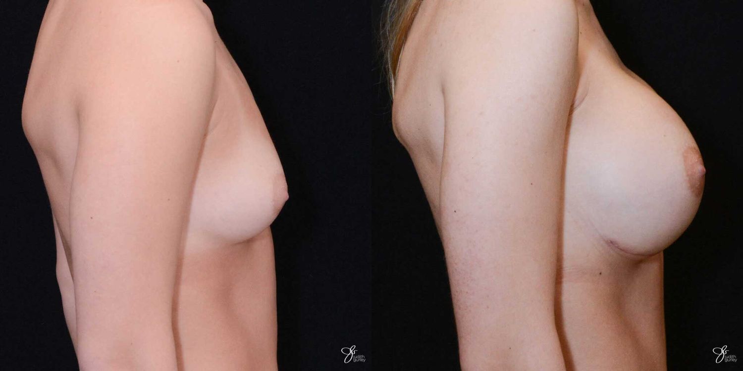 Breast Augmentation Before & After